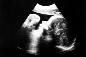 Fetus 7 Month In The Womb. Visible Head And Arms